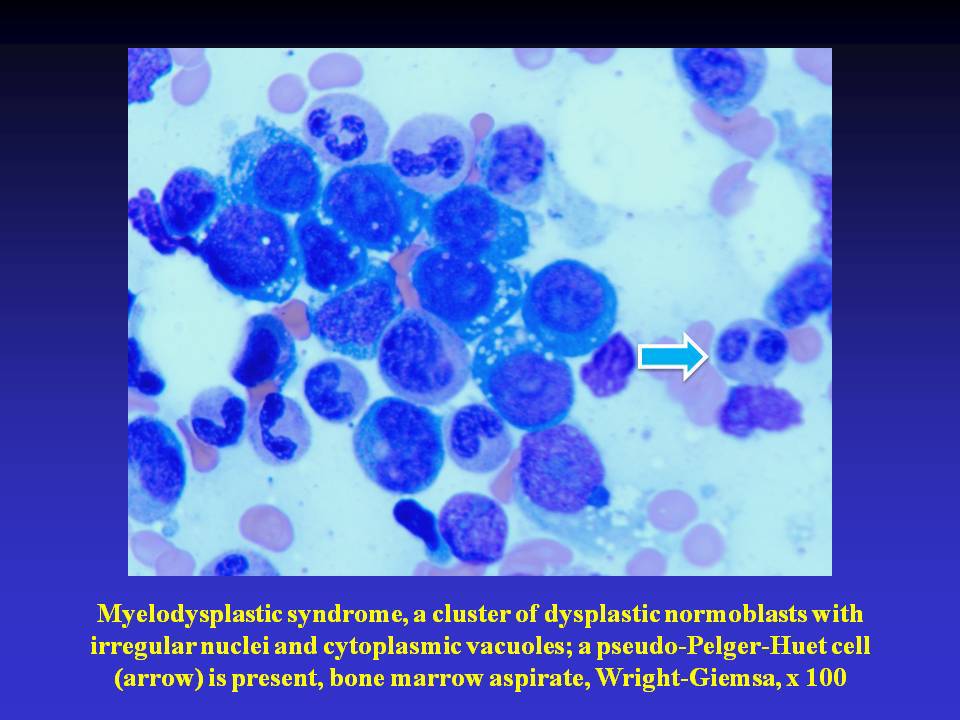 Fig. 2. Myelodysplastic syndrome, a cluster of dysplastic normoblasts with irregular nuclei and cytoplsmic vacuoles; a pseudo-Pelger-Huet cell (arrow) is present, bone marrow aspirate, Wright-Giemsa, x 100